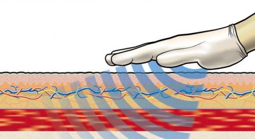 λεμφοίδημα πρήξιμο πόδι