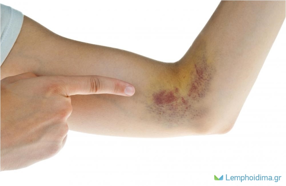 ΑΙΜΑΤΩΜΑΤΑ