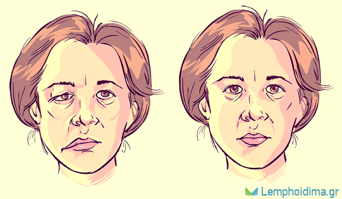 ΠΑΡΕΣΗ ΠΡΟΣΩΠΙΚΟΥ ΝΕΥΡΟΥ ΜΑΛΑΞΗ ΛΕΜΦΙΚΗΣ ΠΑΡΟΧΕΤΕΥΣΗΣ